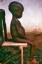 尼日利亚内战中罹患夸休可尔症的孩子