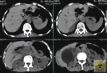 硬化性胆管炎 硬化性胆管炎